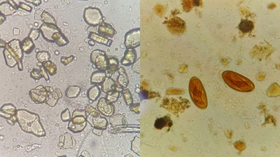 Urinálise e Parasitologia Clínica Avançada