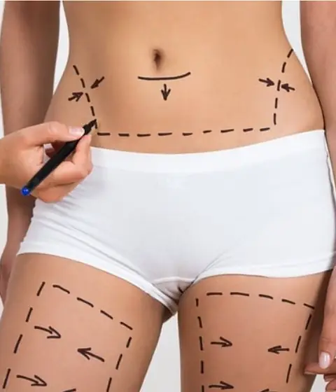 Marcação de cirurgia plástica no abdômen e nas pernas, contexto de drenagem pós-operatória
