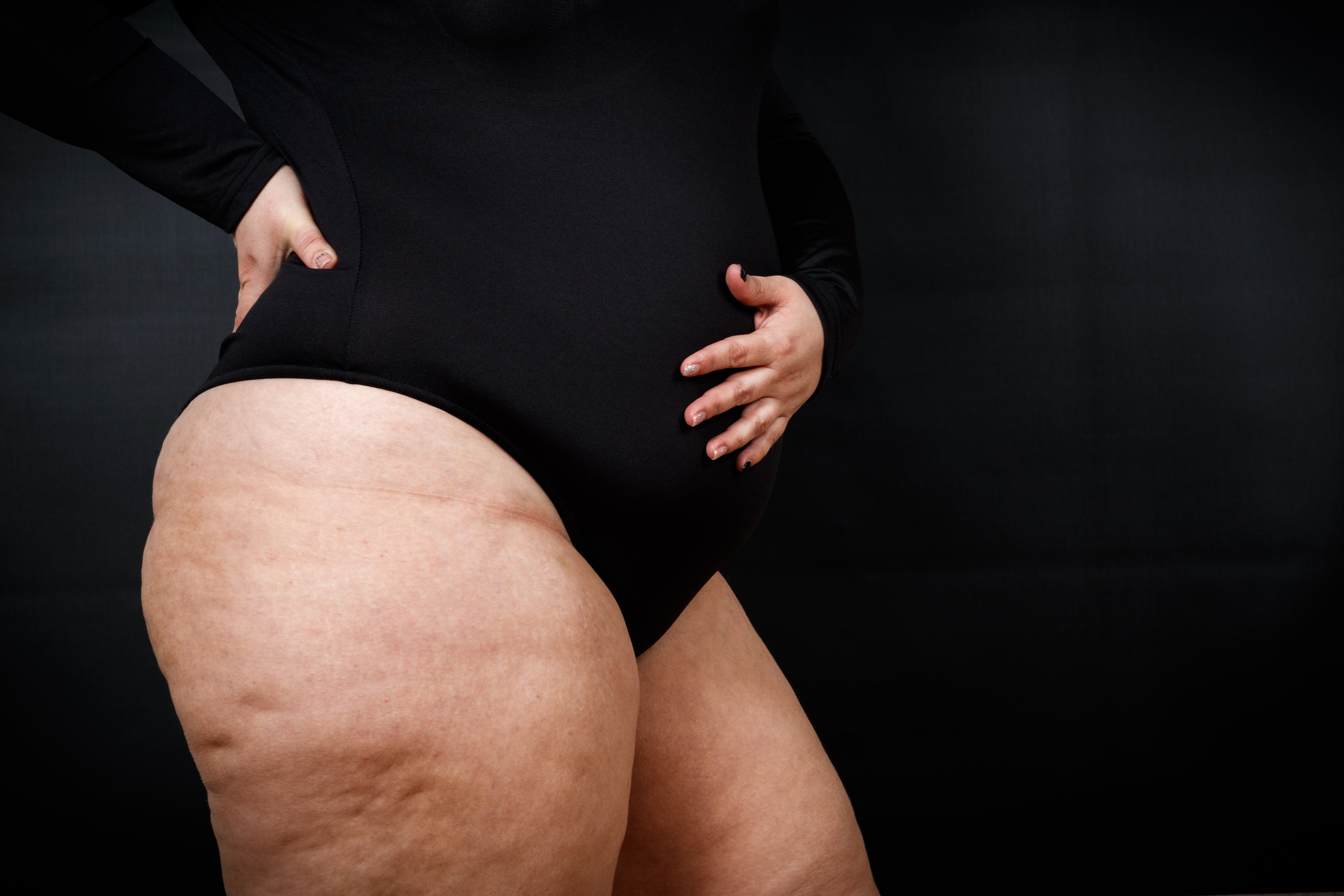Mulher com acúmulo de gordura nas pernas e quadris, sinal comum do lipedema