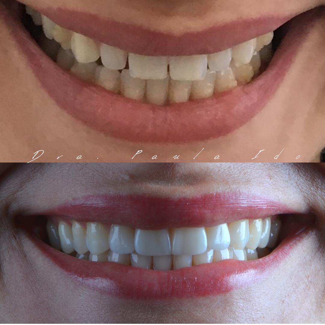 Comparativo de antes e depois de tratamento odontológico