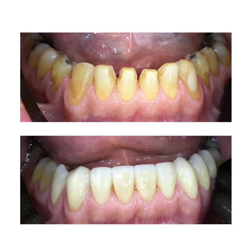 Comparativo de antes e depois de tratamento odontológico