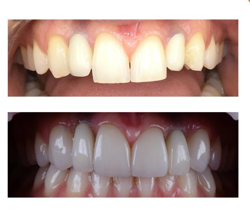 Comparativo de antes e depois de tratamento odontológico