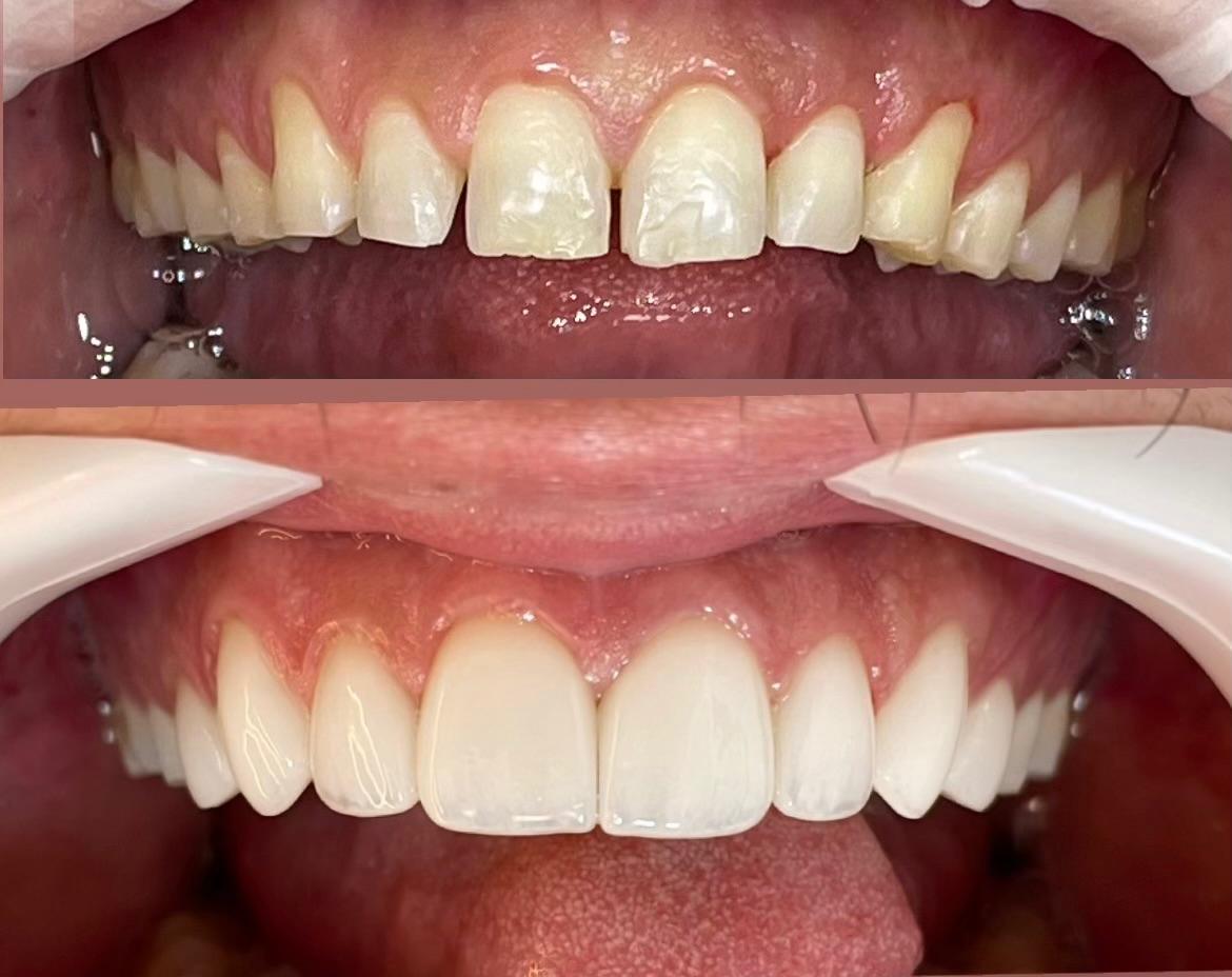 Comparativo de antes e depois de tratamento odontológico