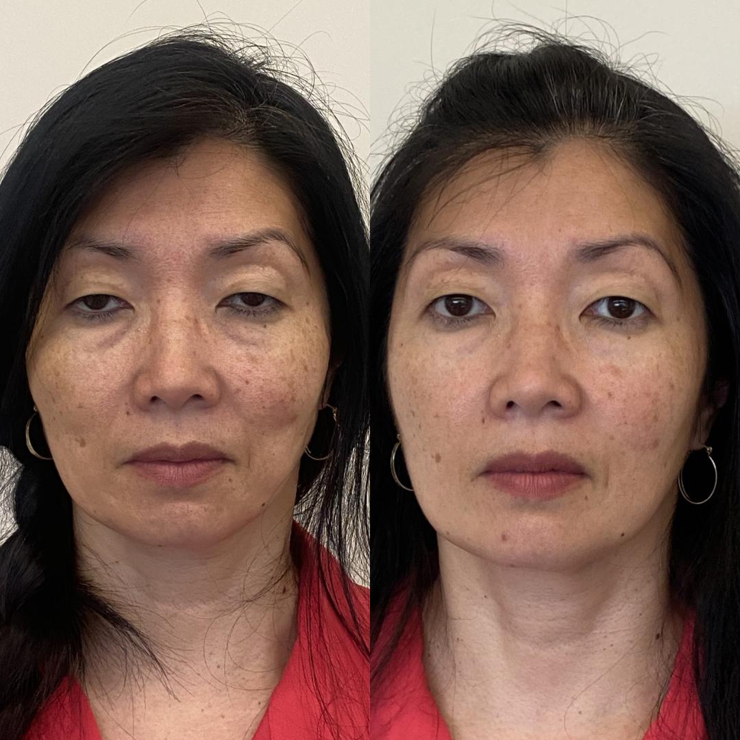 Antes e depois de harmonização facial