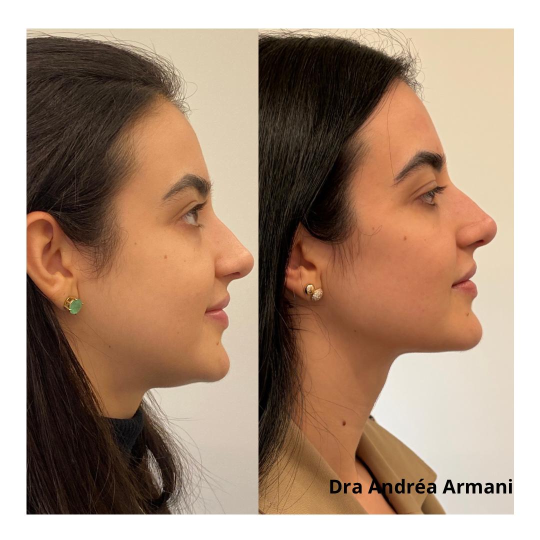 Antes e depois de harmonização facial