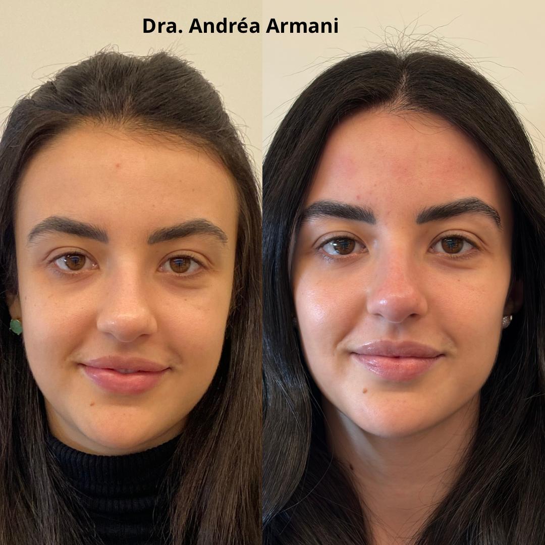 Antes e depois de harmonização facial